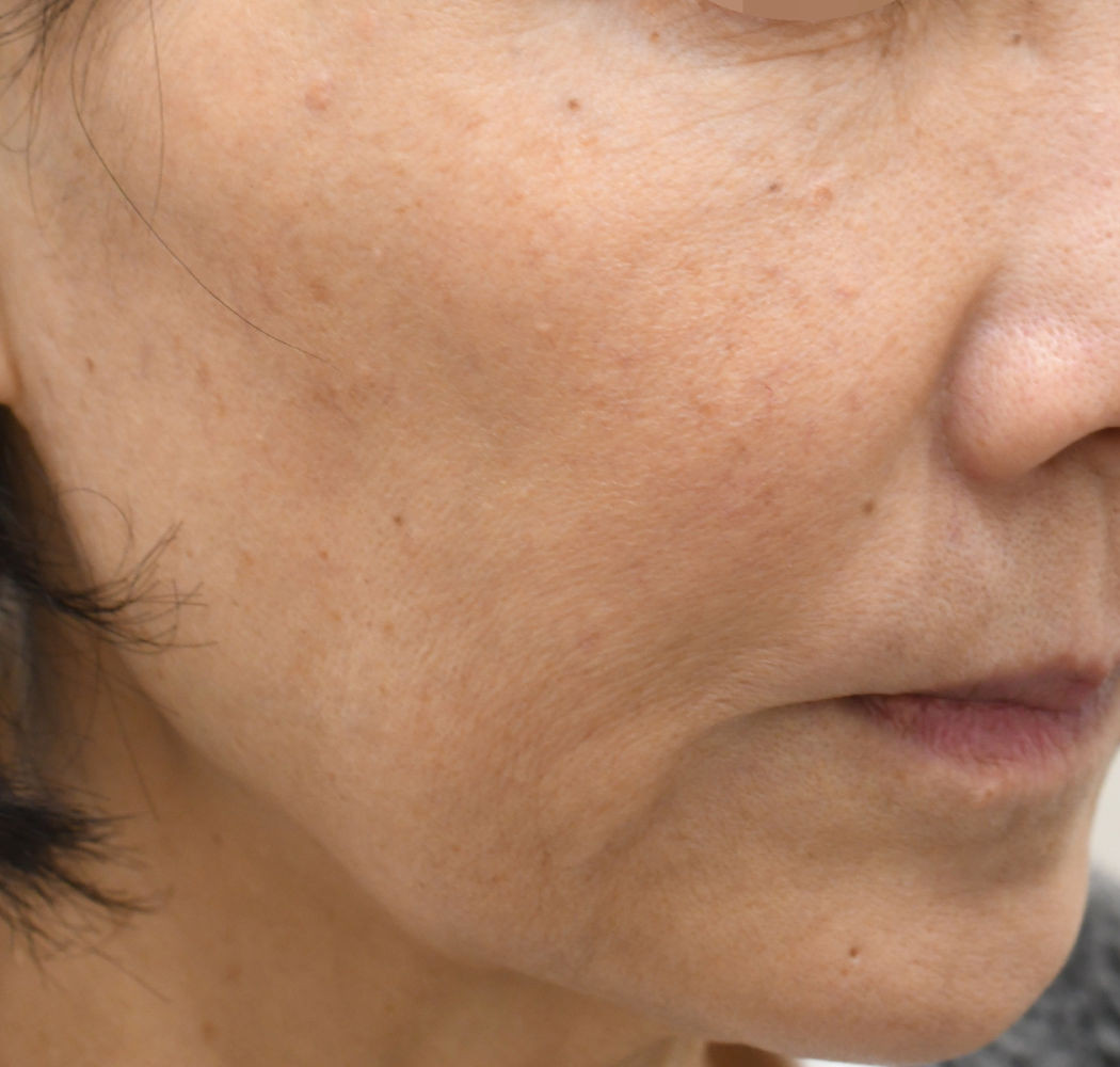 プロファイロ 症例 右 治療前