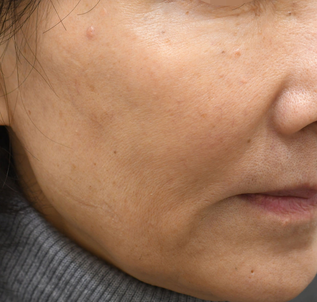 プロファイロ 症例 右 1ヶ月後