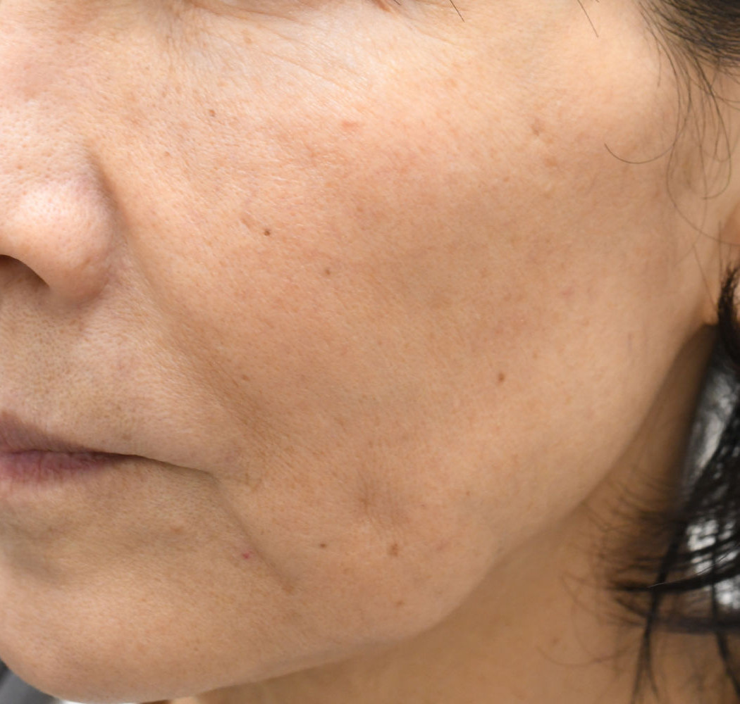 プロファイロ 症例 左 治療前