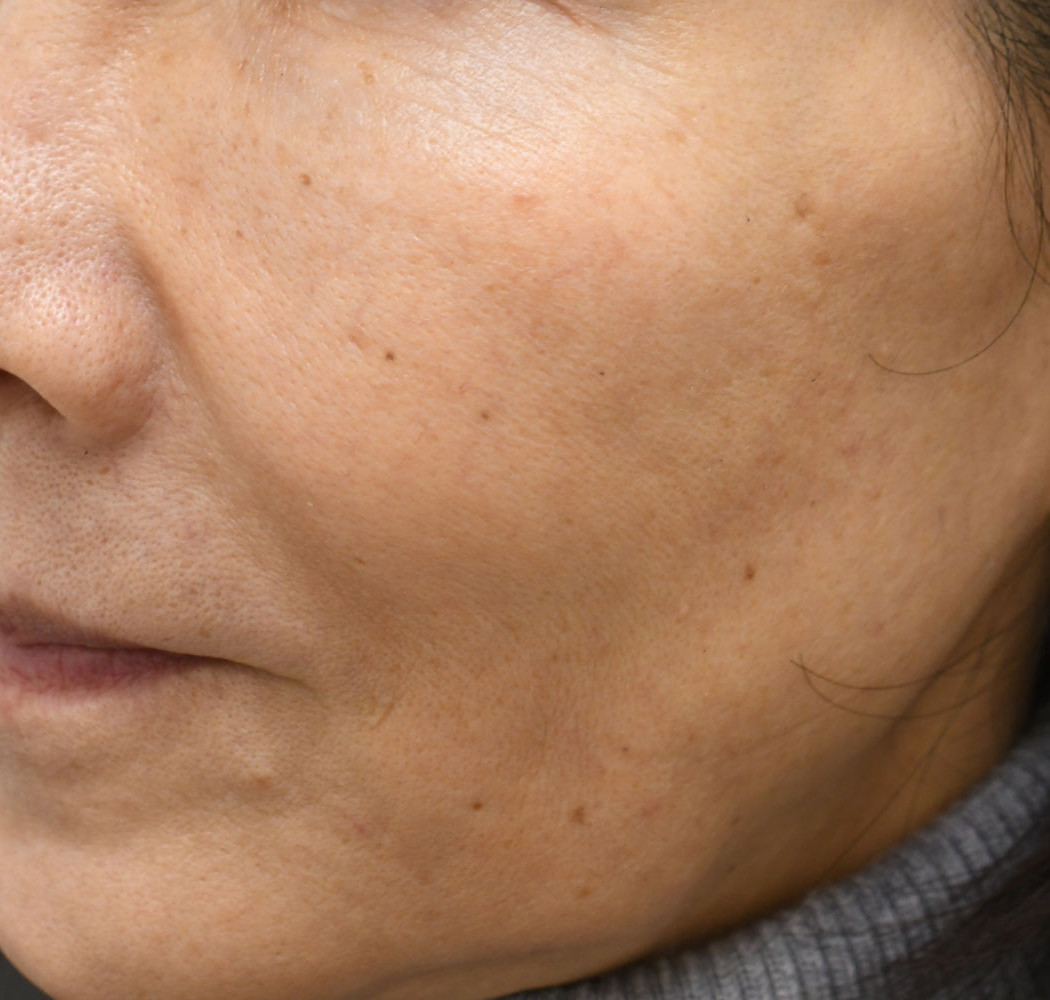 プロファイロ 症例 左 1ヶ月後