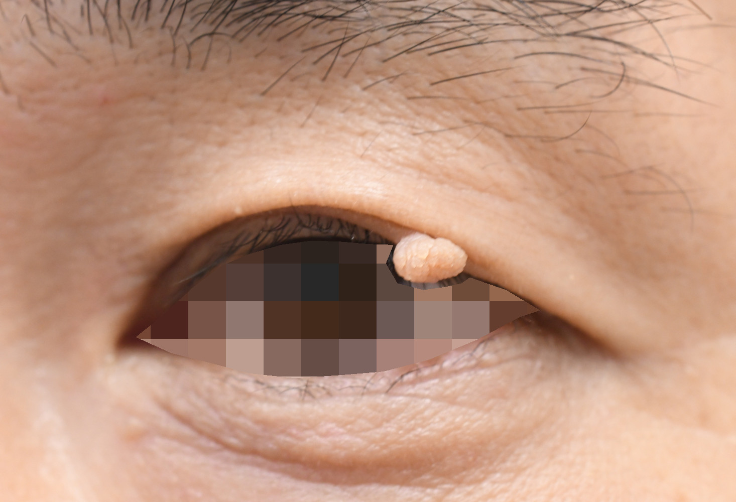 左上眼瞼軟性線維腫摘出 治療前