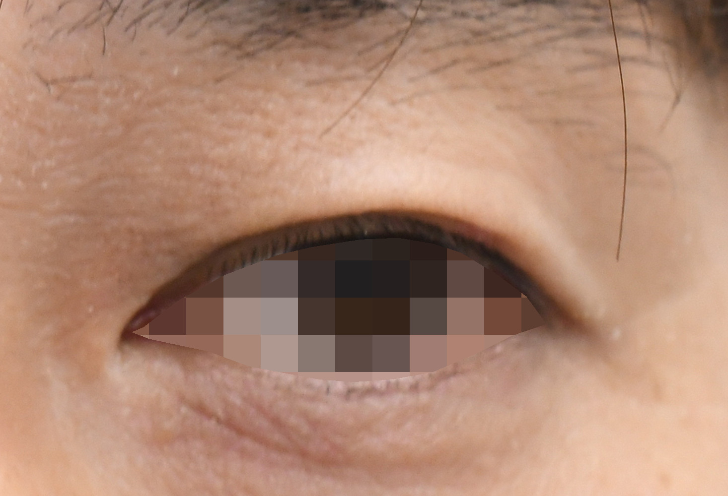 左上眼瞼軟性線維腫摘出 術後10日